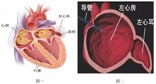 你有所不知的左心耳封堵术