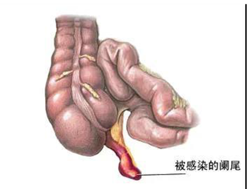 认识阑尾