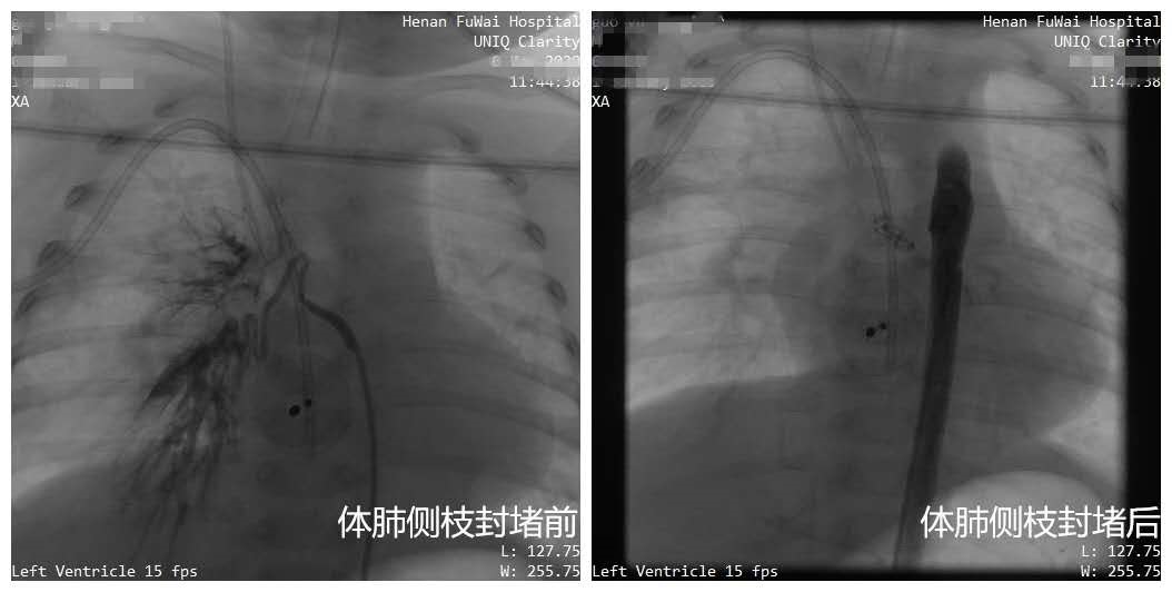 新生儿肺炎久治不愈 竟然是因为体内多了一根血管 最新快讯 资讯动态 阜外华中心血管病医院