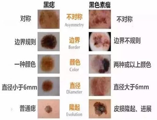 黑色素瘤起源于黑色素细胞,黑色素细胞在我们皮肤下面正常情况下是
