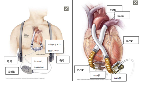 人工心脏 您了解吗 健康科普 护理园地 阜外华中心血管病医院