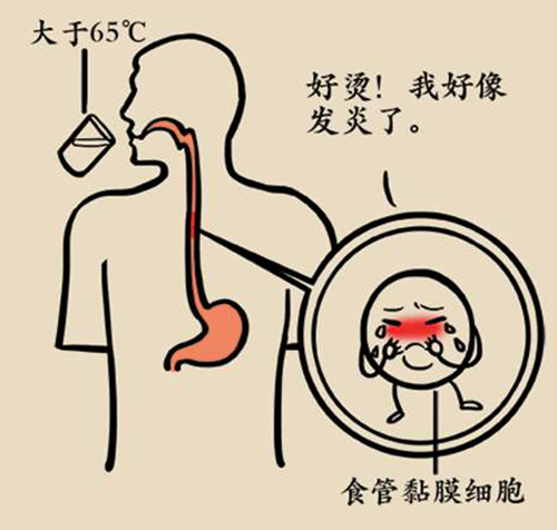 吃出来的食管癌