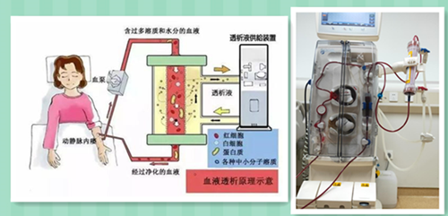 一旦透析 就要一辈子吗 答案是 健康科普 护理园地 阜外华中心血管病医院 一旦透析 就要一辈子吗 答案是 健康科普 护理园地 阜外华中心血管病医院