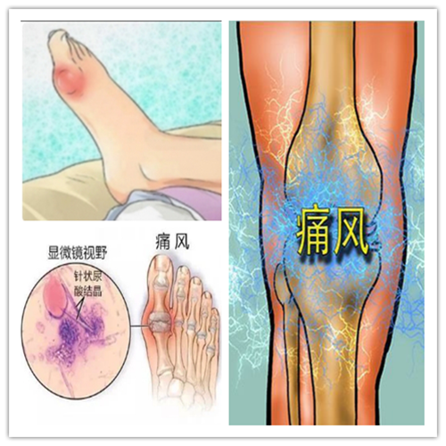 手痛脚痛可能是因为它 千万别当成韧带拉伤 健康科普 护理园地 阜外华中心血管病医院 手痛脚痛可能是因为它 千万别当成韧带拉伤 健康科普 护理园地 阜外华中心血管病医院