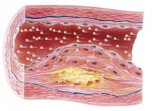 我国高血压的知晓率,治疗率,控制率普遍都不高,所以很多主动脉夹层