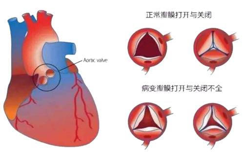 你有所不知的风湿性心脏病 健康科普 护理园地 阜外华中心血管病医院