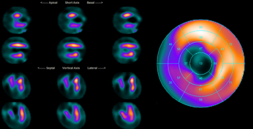 核素心肌灌注显像小科普 - 健康科普 - 护理园地 - 阜外华中心血管病