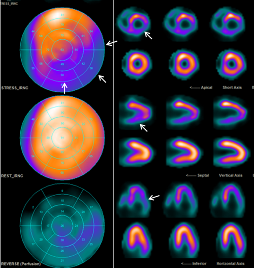 核素心肌灌注显像小科普 - 健康科普 - 护理园地 - 阜外华中心血管病