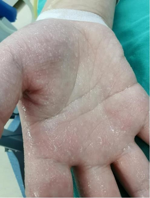 今天水滴成河隔天干燥清爽只要1天手汗症患者的痛苦就能一去不返