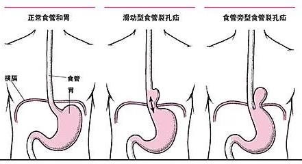 这种胸痛跟心脏无关是胃悄悄搬了家