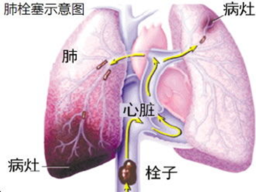 磕磕碰碰勿大意 小心肺栓塞偷袭 健康科普 护理园地 阜外华中心血管病医院