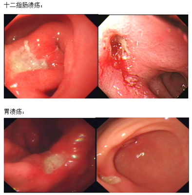 紧张人群精神状态会影响胃液分泌长期处于紧张状态,易导致消化性溃疡