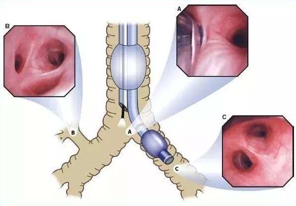 的方式,当一侧肺萎陷时,可进行另一侧单肺通气或两肺分别进行机械呼吸